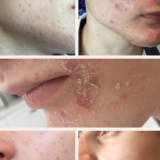 acnelan-acne-treatment